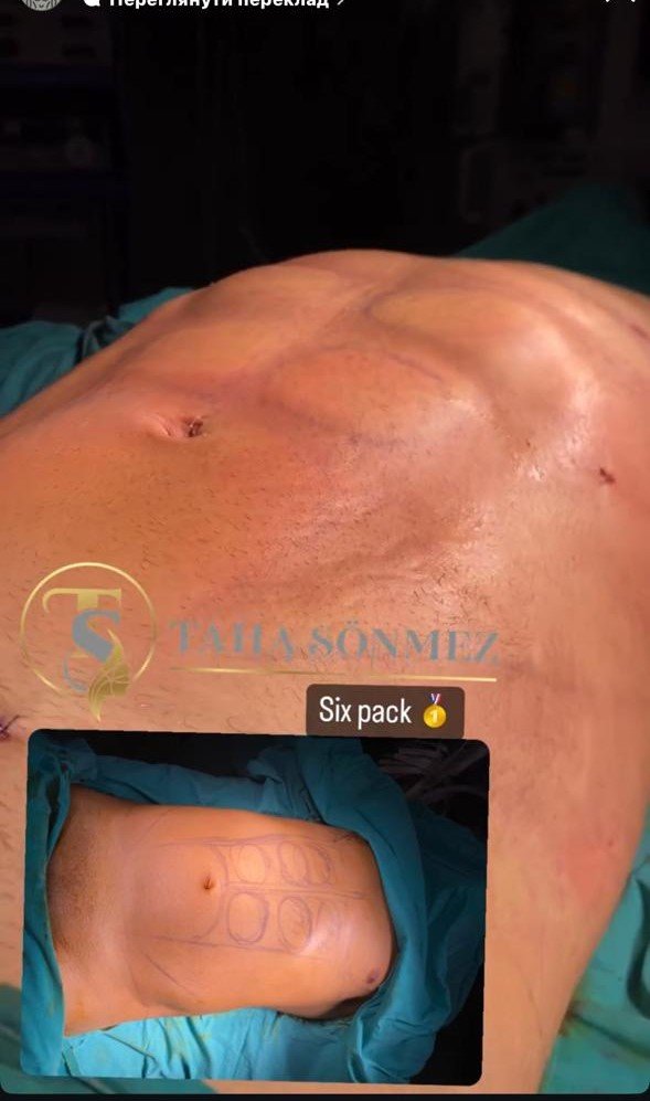 Before and after result by Dr. Taha Sönmez