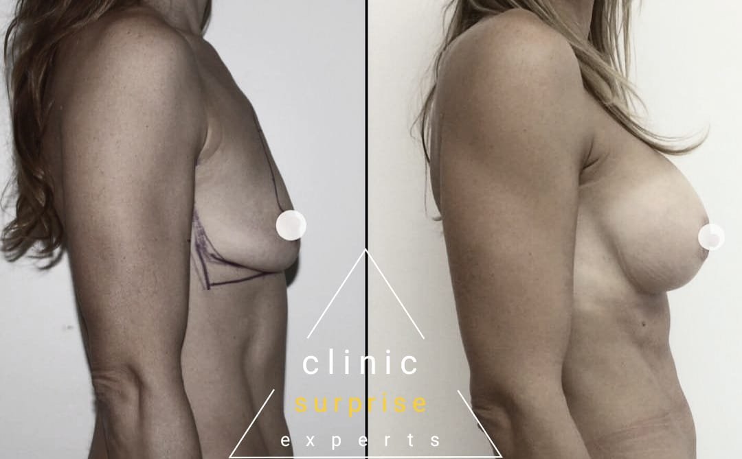 Before and after result by Dr. Taha Sönmez