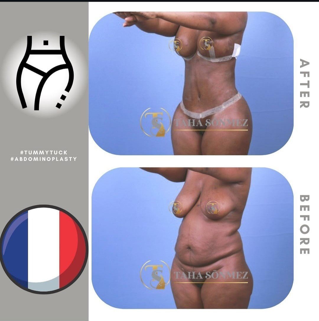 Before and after result by Dr. Taha Sönmez