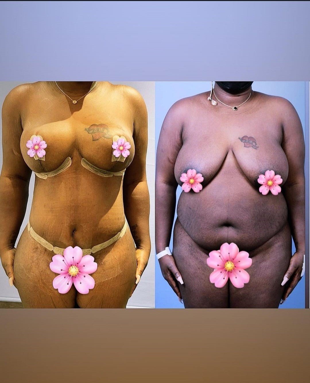 Before and after result by Dr. Taha Sönmez