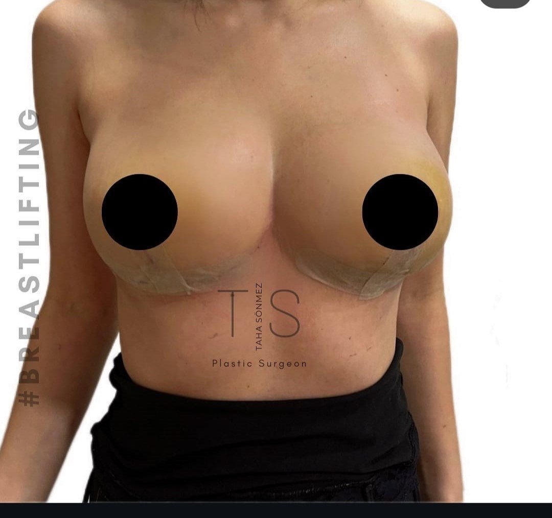 Before and after result by Dr. Taha Sönmez