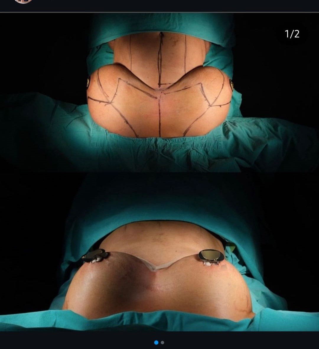 Before and after result by Dr. Taha Sönmez