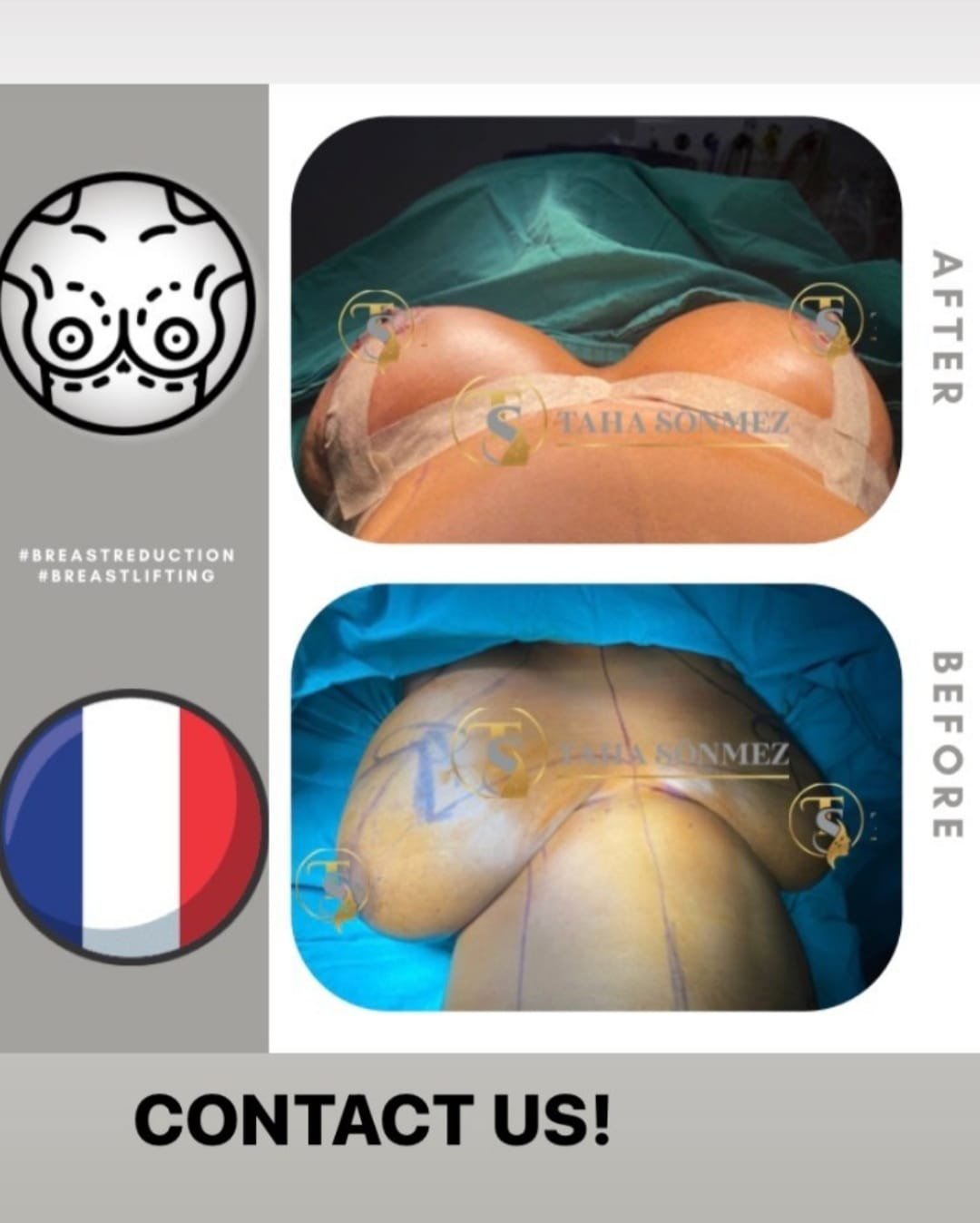 Before and after result by Dr. Taha Sönmez