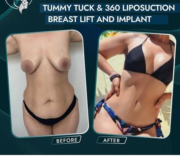 Before and after result by Dr. Taha Sönmez