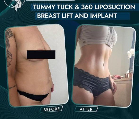 Before and after result by Dr. Taha Sönmez