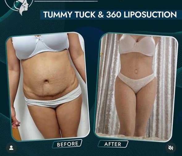 Before and after result by Dr. Taha Sönmez