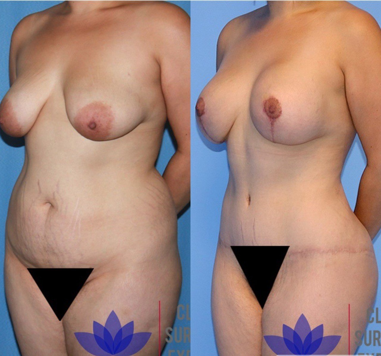Before and after result by Dr. Taha Sönmez