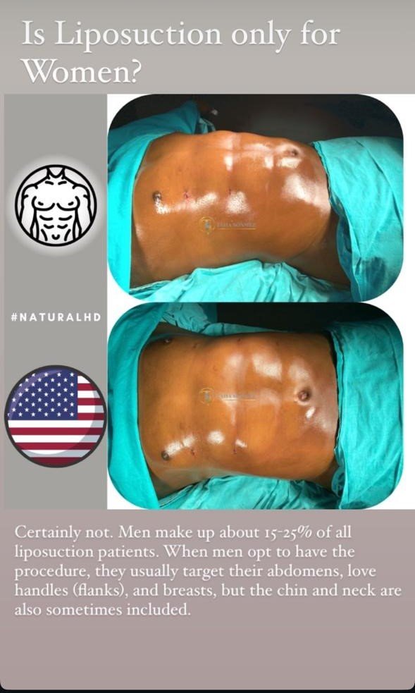 Before and after result by Dr. Taha Sönmez