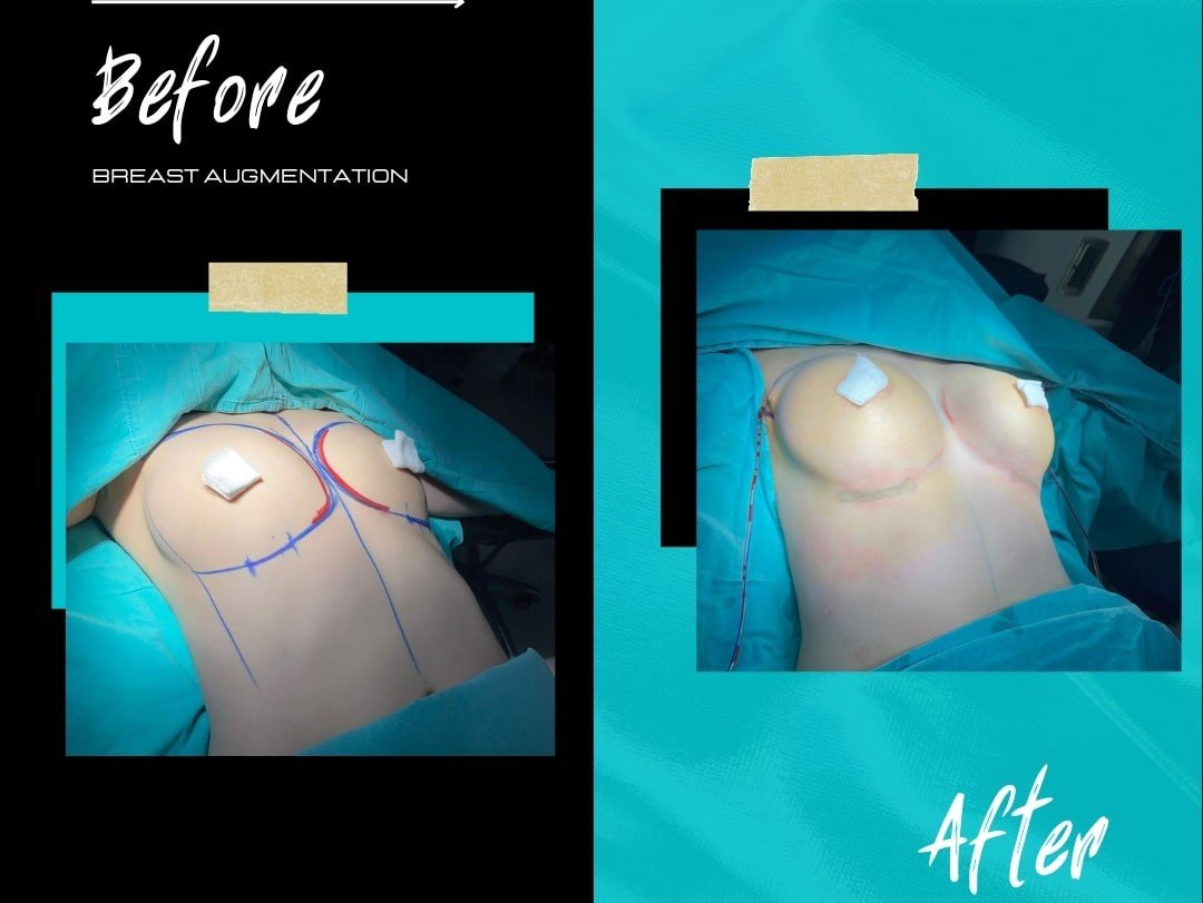 Before and after result by Dr. Taha Sönmez