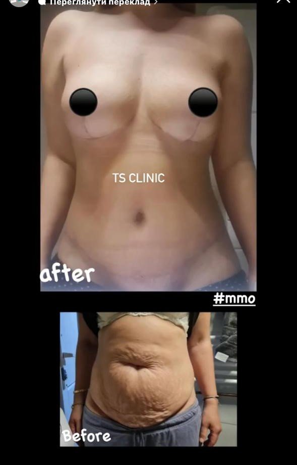 Before and after result by Dr. Taha Sönmez