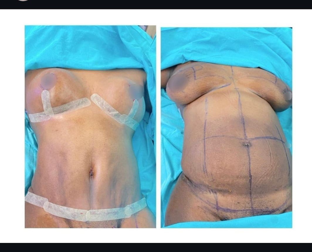 Before and after result by Dr. Taha Sönmez