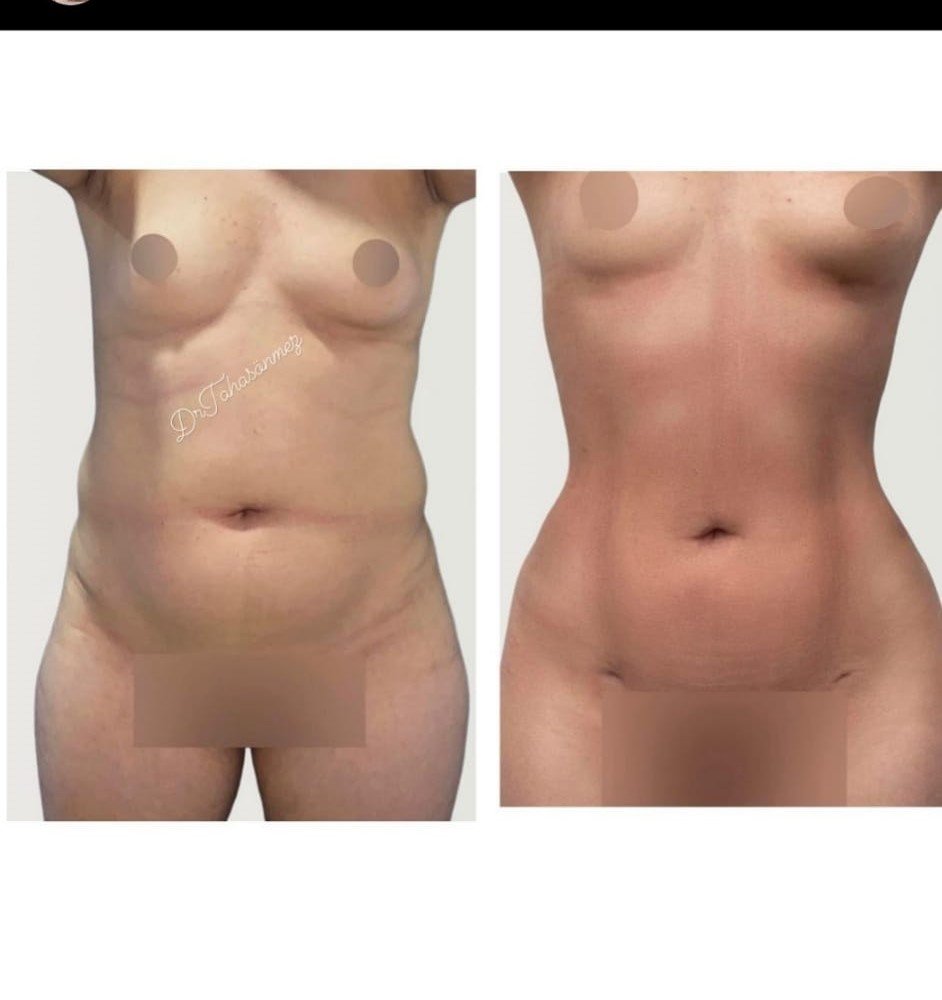 Before and after result by Dr. Taha Sönmez