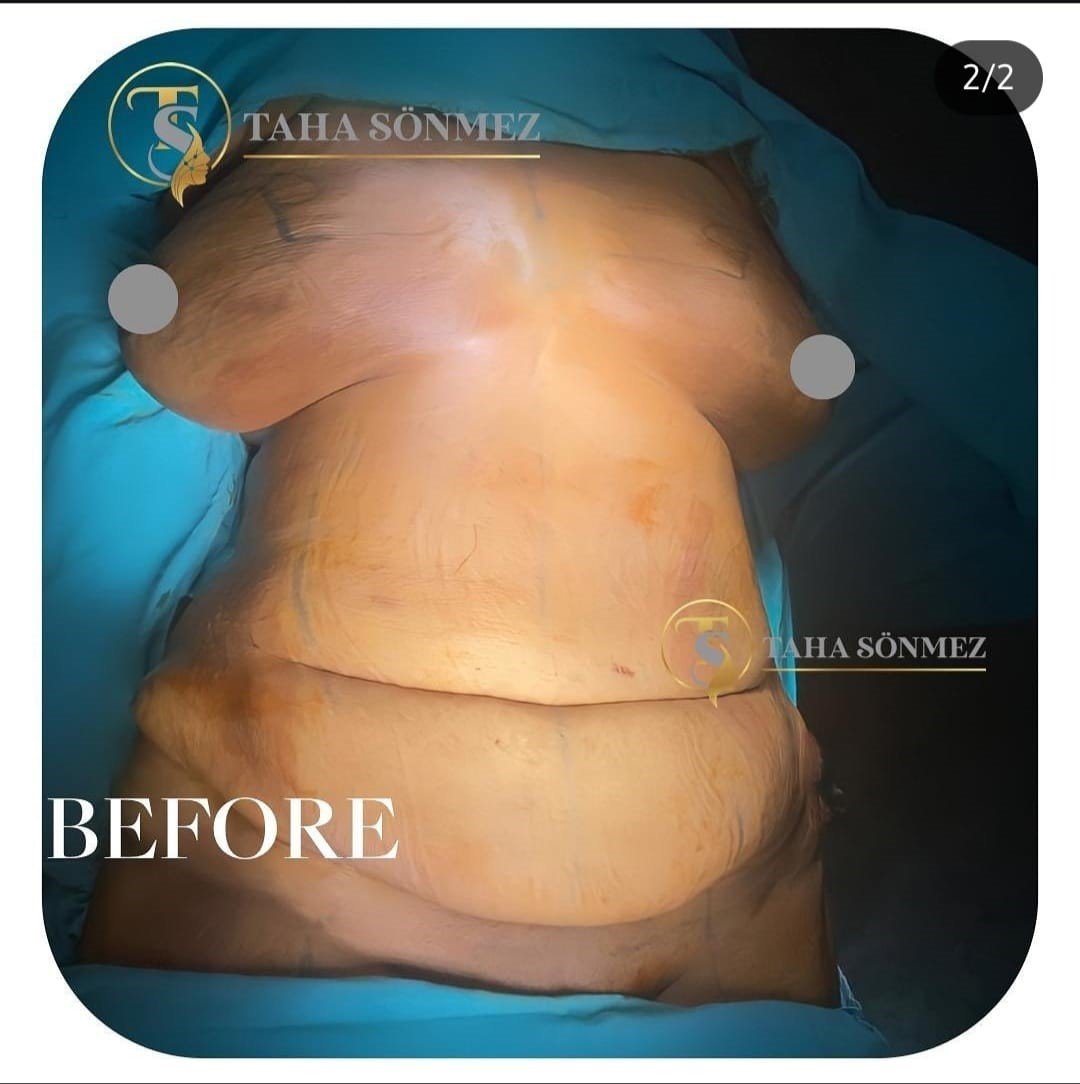 Before and after result by Dr. Taha Sönmez