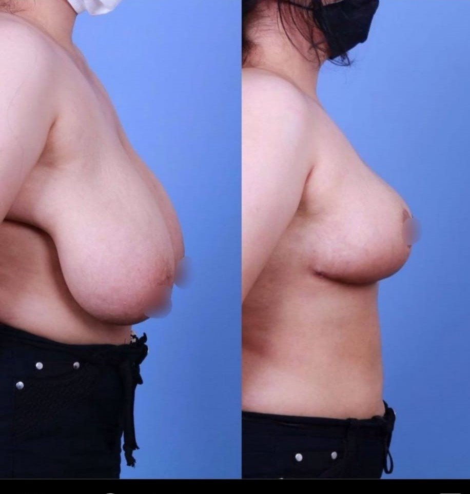 Before and after result by Dr. Taha Sönmez