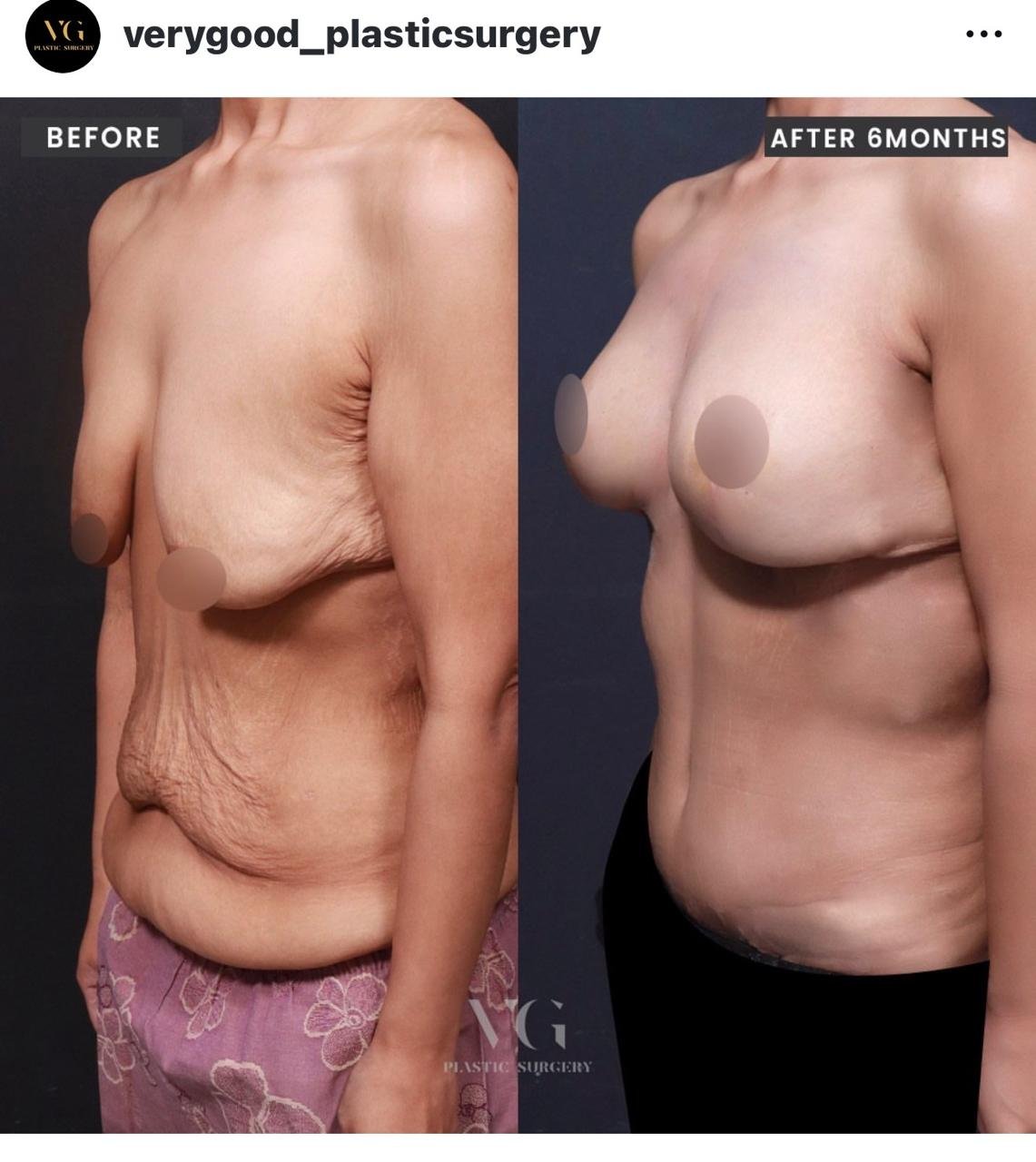 Before and after result by Dr. Im Young Min