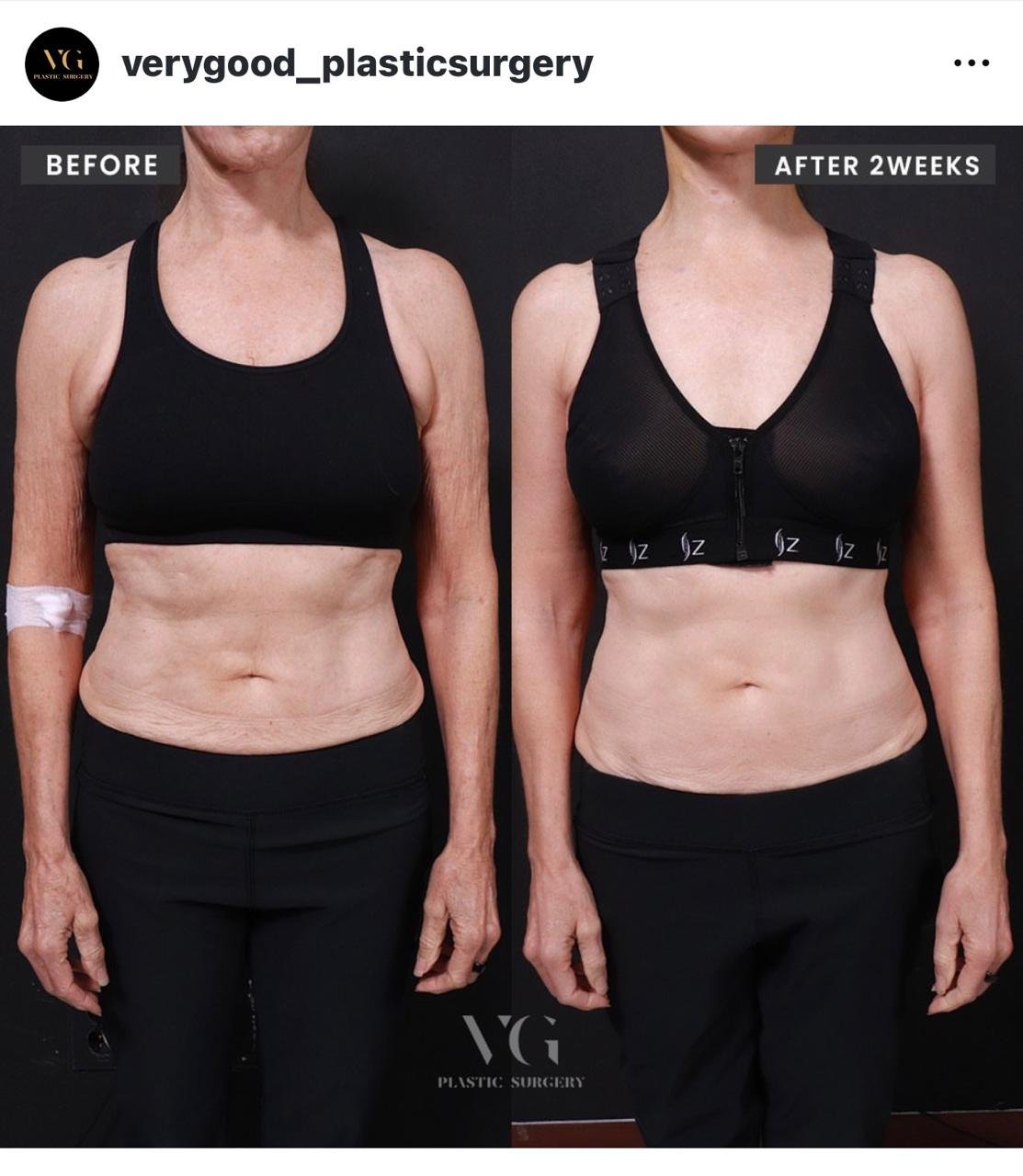Before and after result by Dr. Kim Yong Woo
