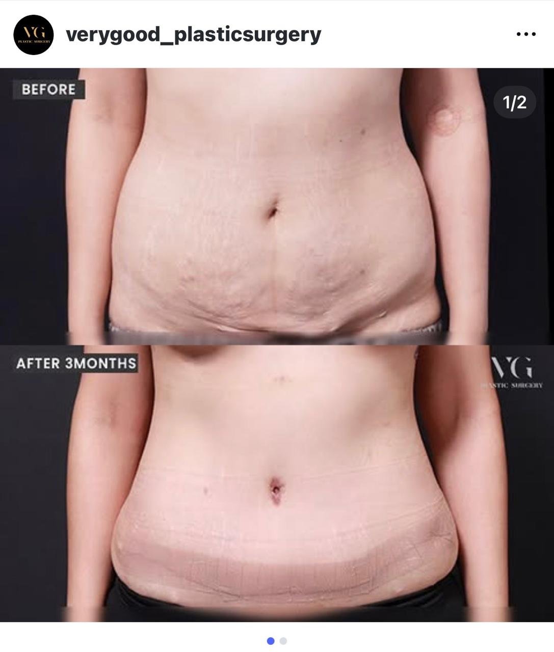 Before and after result by Dr. Kim Yong Woo