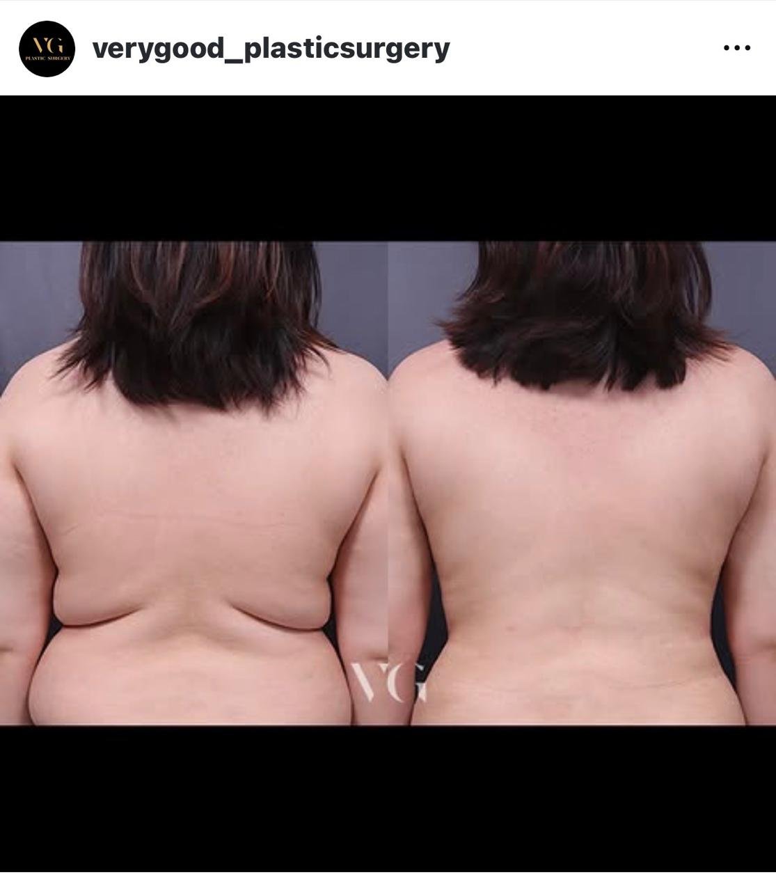 Before and after result by Dr. Im Young Min