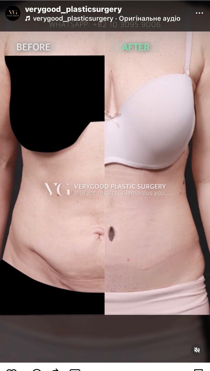 Before and after result by Dr. Kim Yong Woo