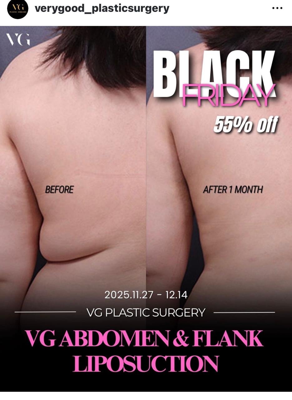 Before and after result by Dr. Im Young Min