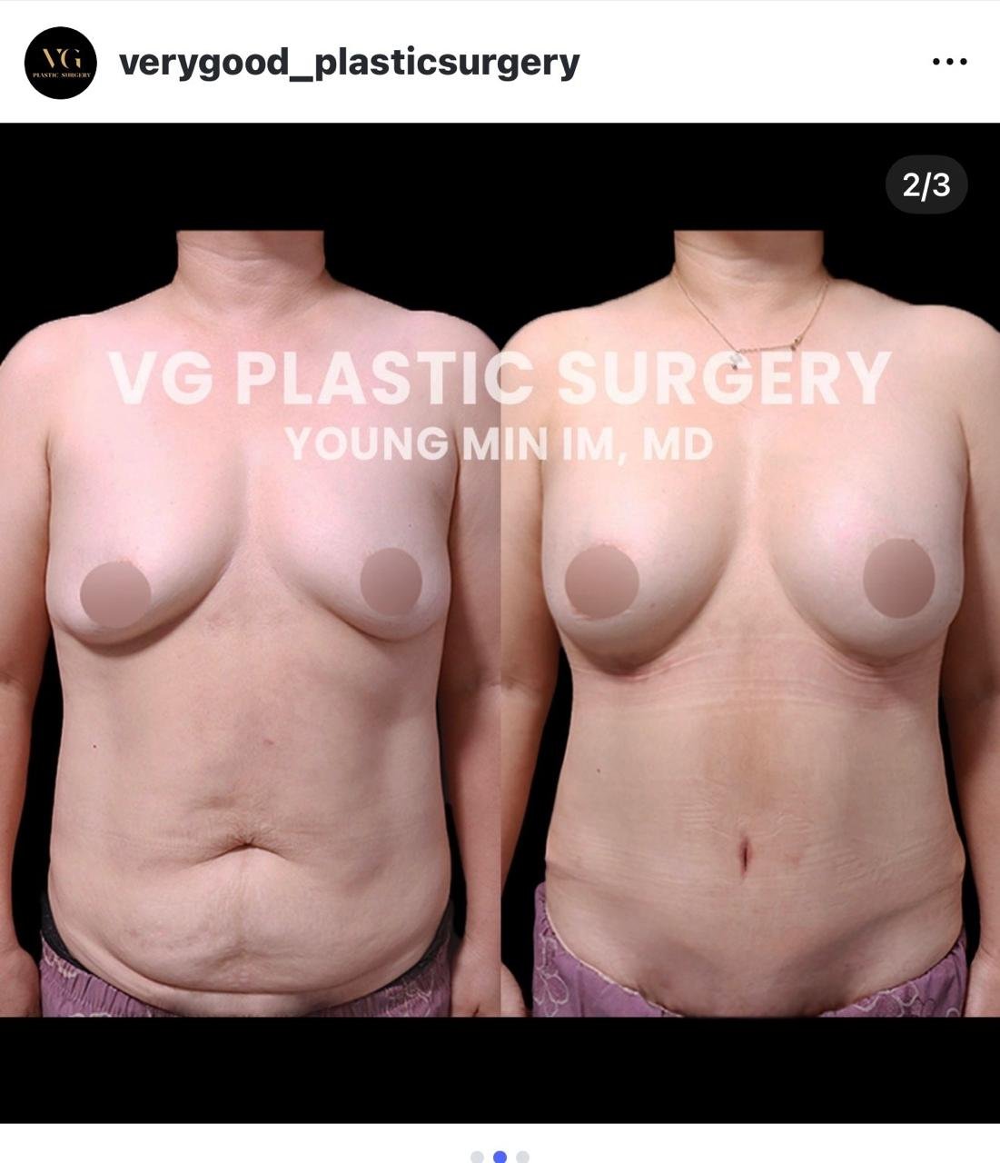 Before and after result by Dr. Im Young Min