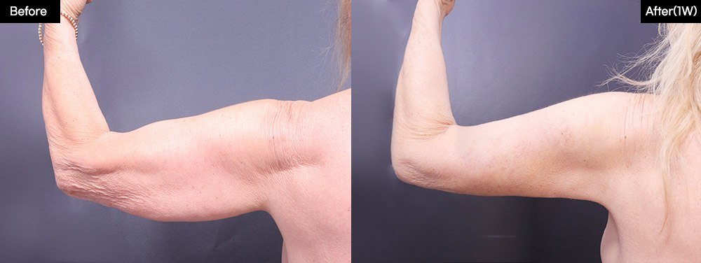 Before and after result by Dr. Kim Yong Woo