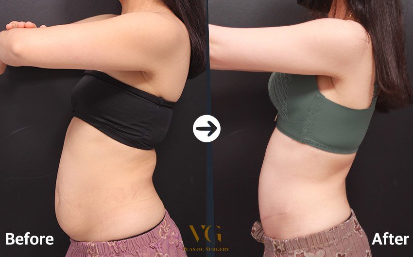 Before and after result by Dr. Im Young Min