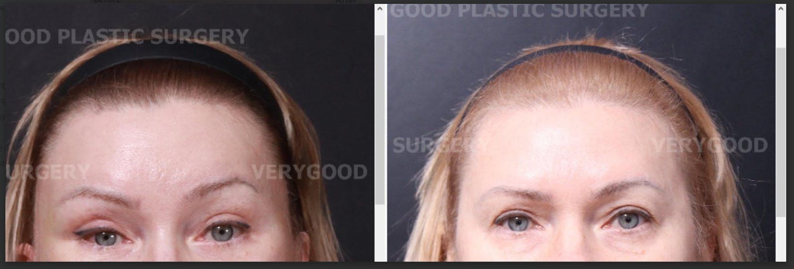 Before and after result by Dr. Kim Yong Woo
