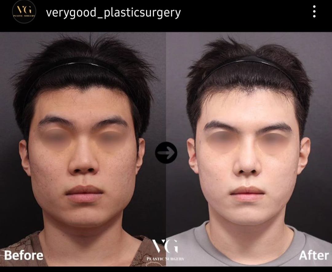 Before and after result by Dr. Kim Yong Woo