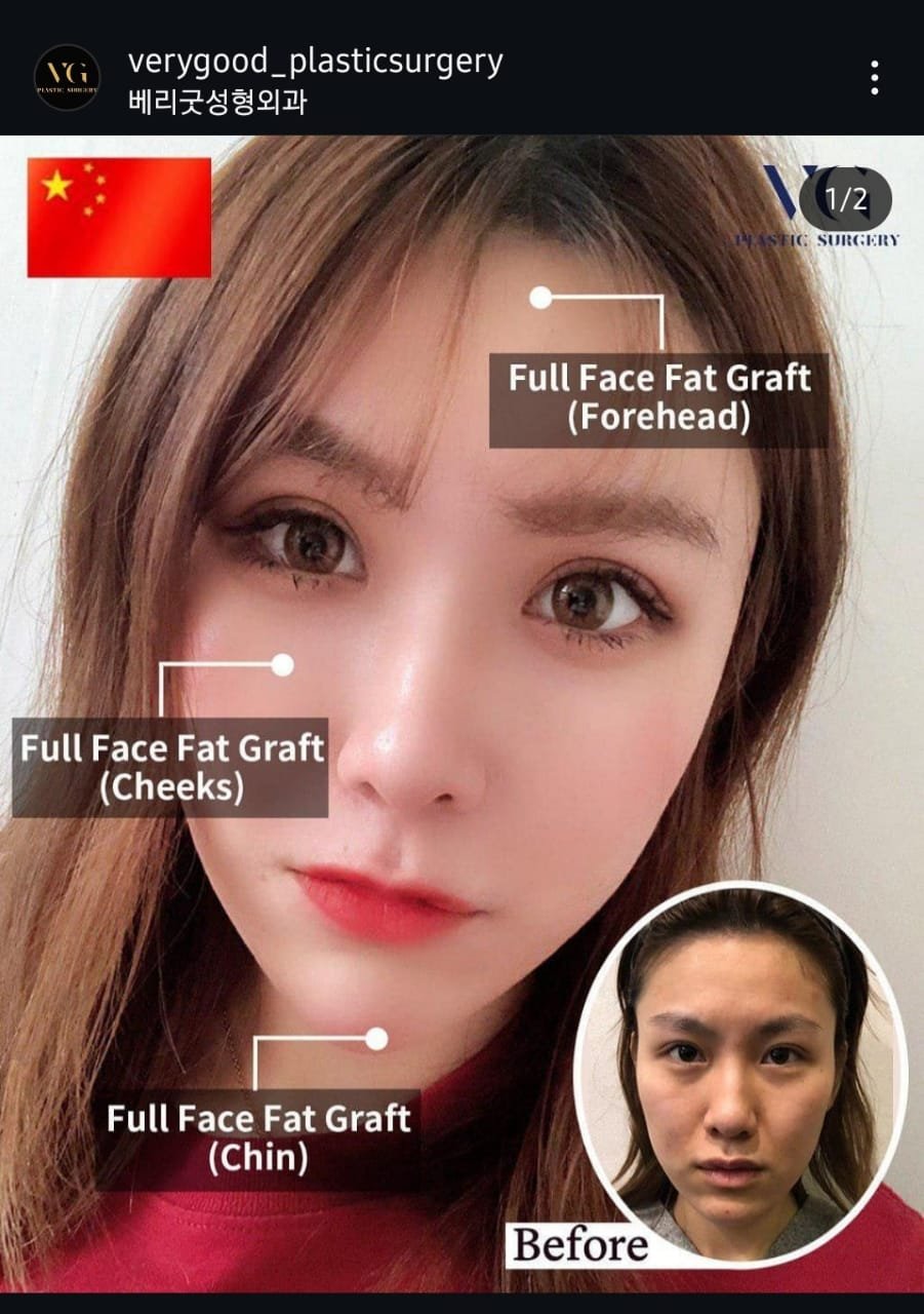 Before and after result by Dr. Kim Yong Woo