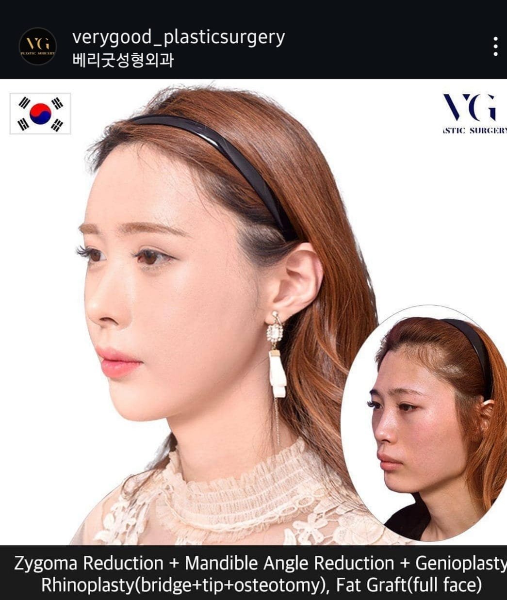 Before and after result by Dr. Im Young Min