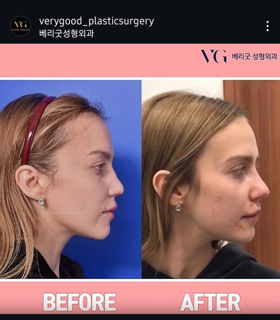 Before and after result by Dr. Kim Yong Woo