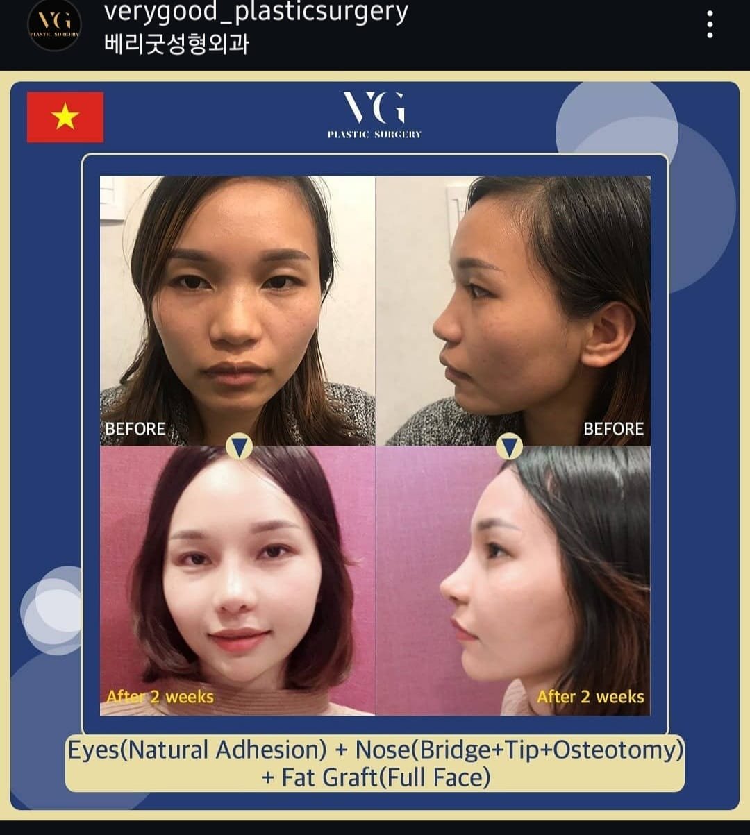 Before and after result by Dr. Im Young Min