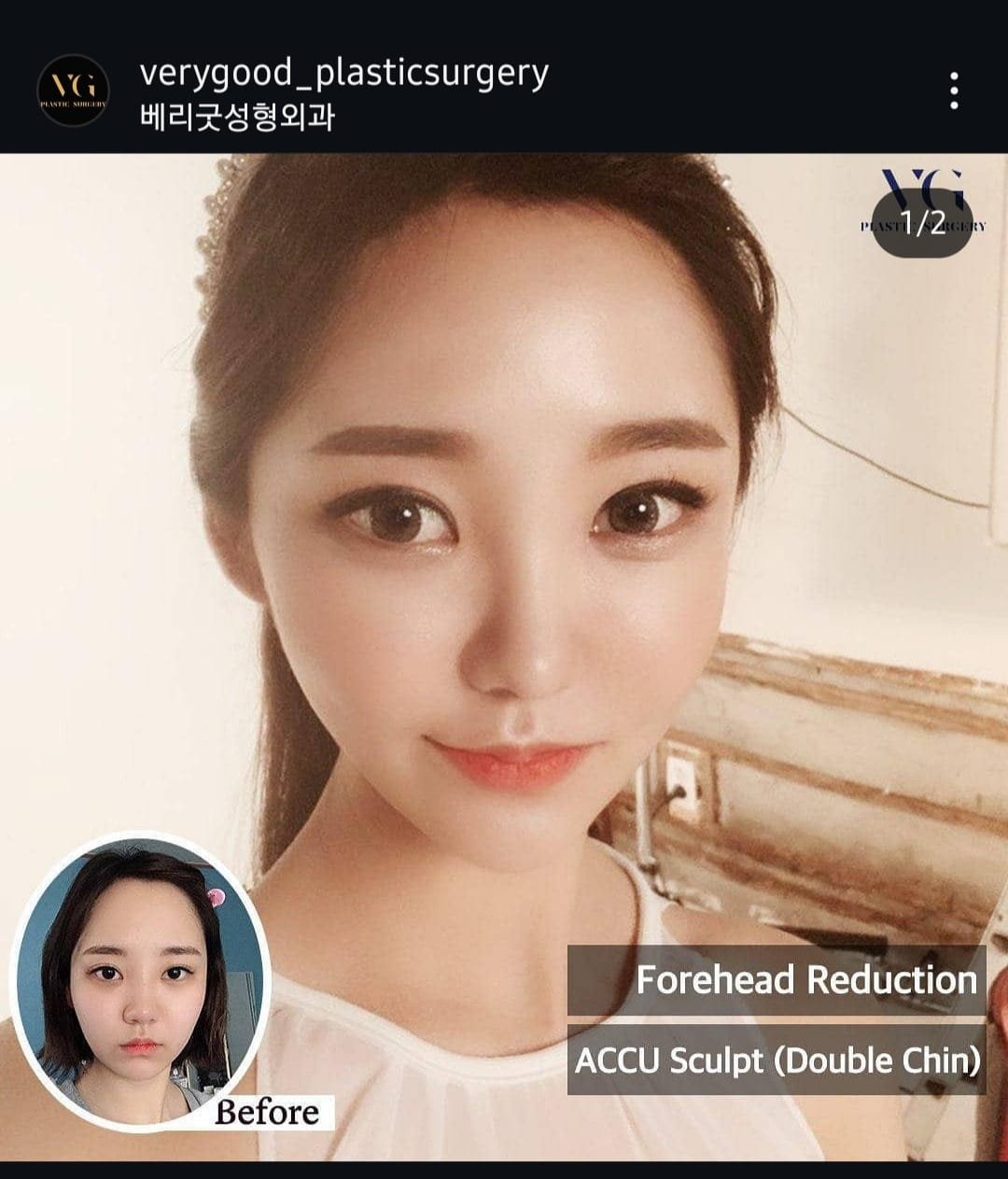 Before and after result by Dr. Kim Yong Woo