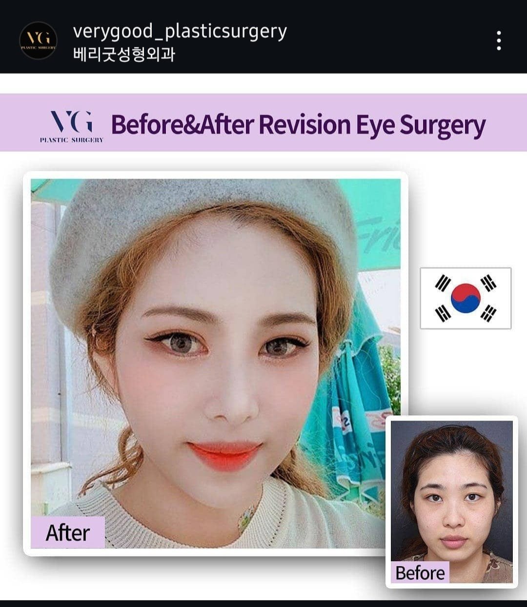 Before and after result by Dr. Im Young Min
