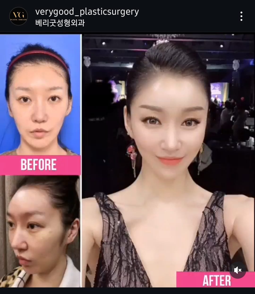Before and after result by Dr. Kim Yong Woo
