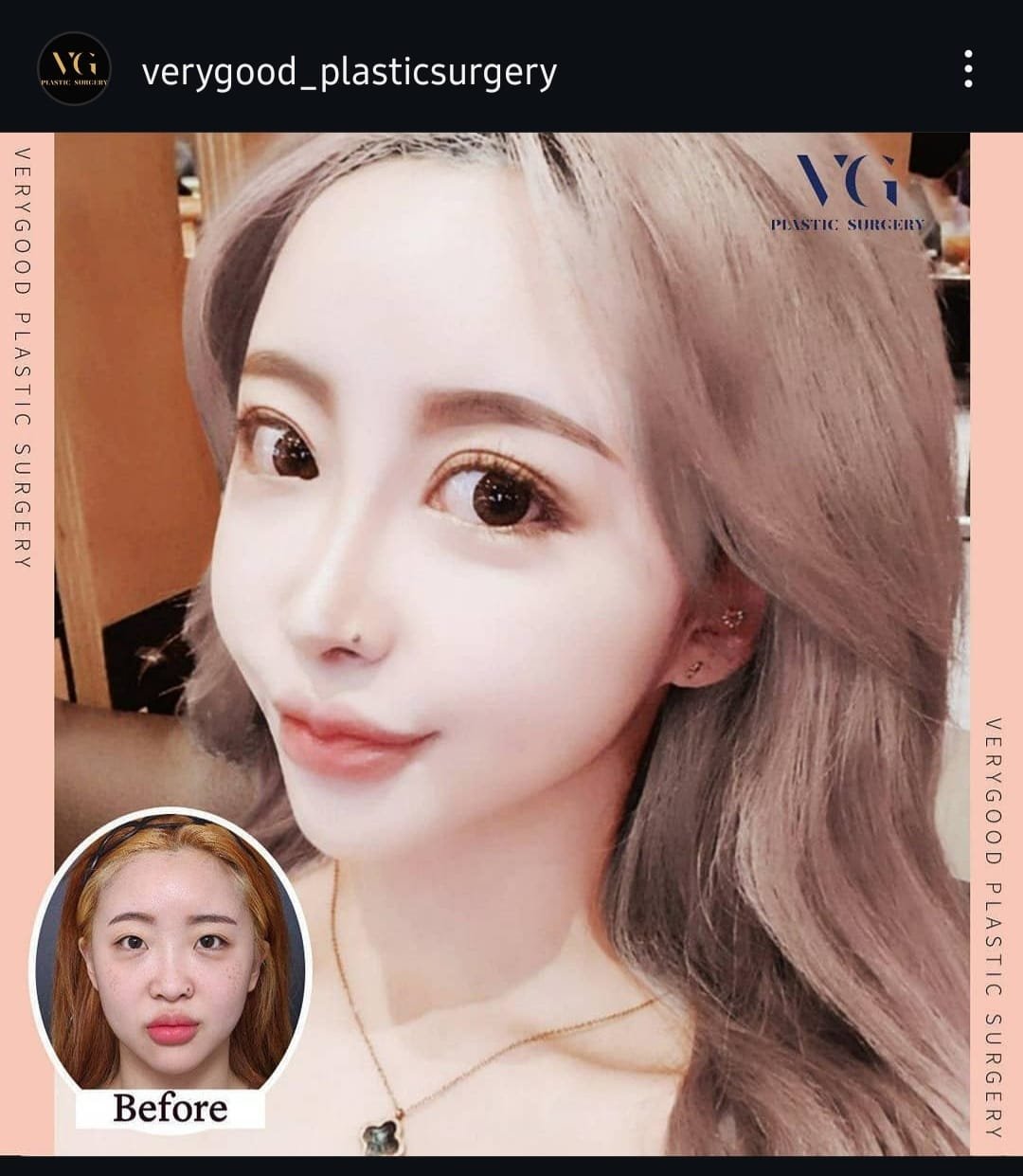 Before and after result by Dr. Im Young Min
