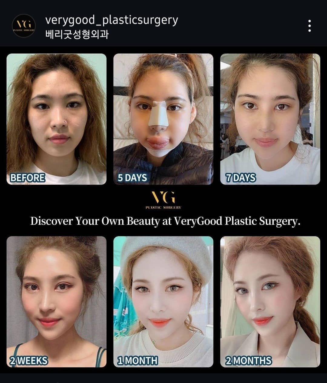 Before and after result by Dr. Kim Yong Woo