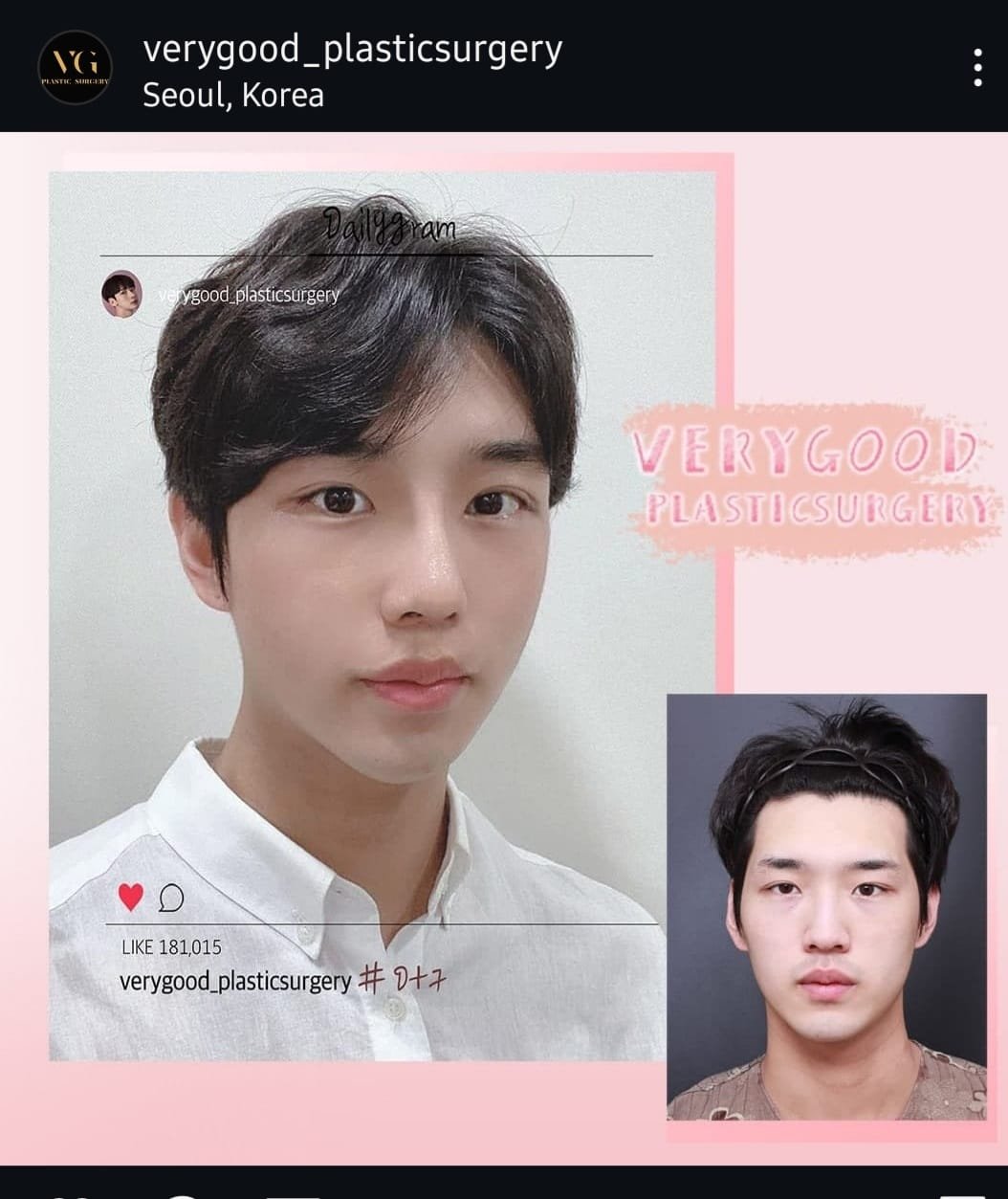 Before and after result by Dr. Im Young Min