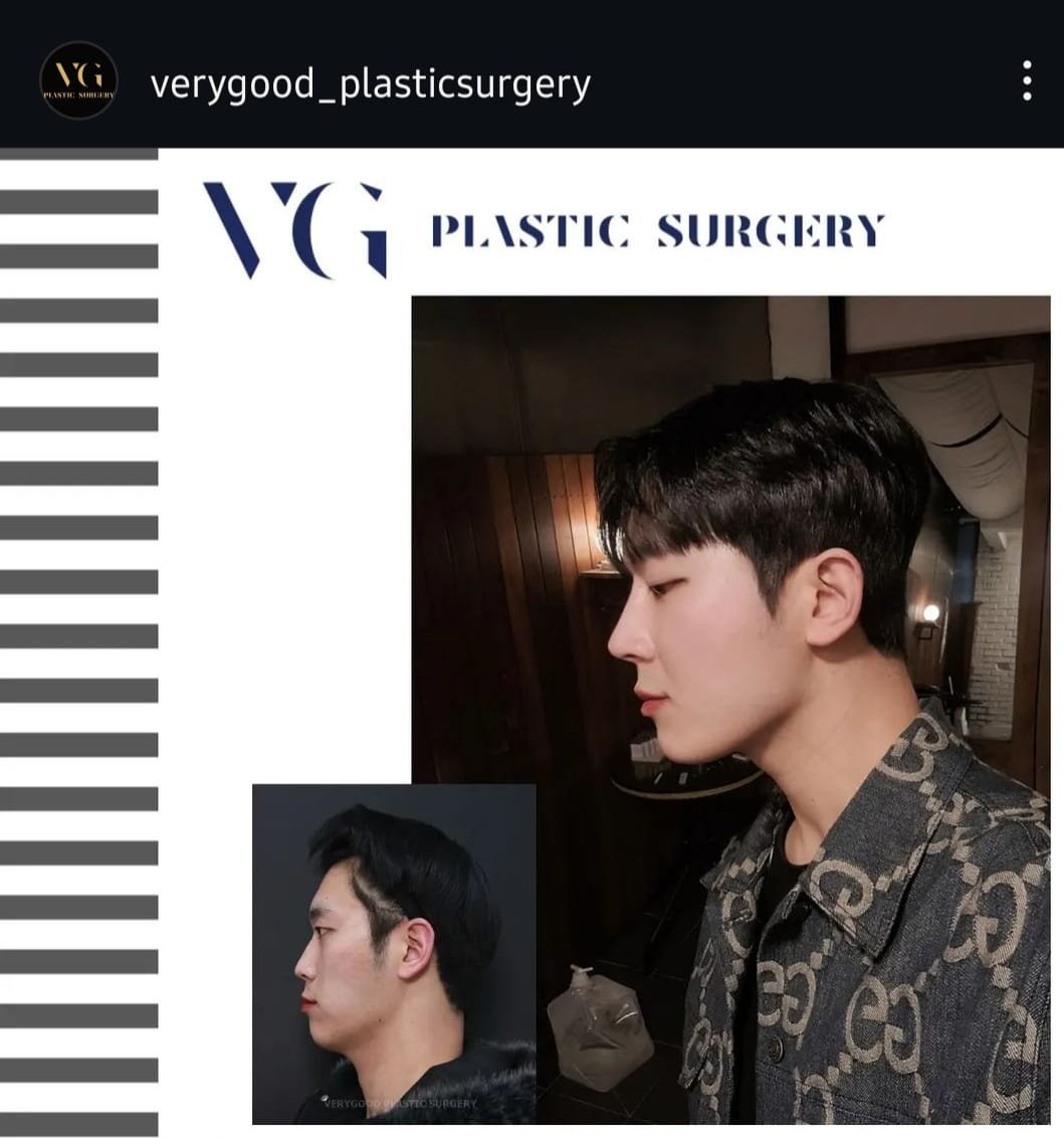 Before and after result by Dr. Kim Yong Woo