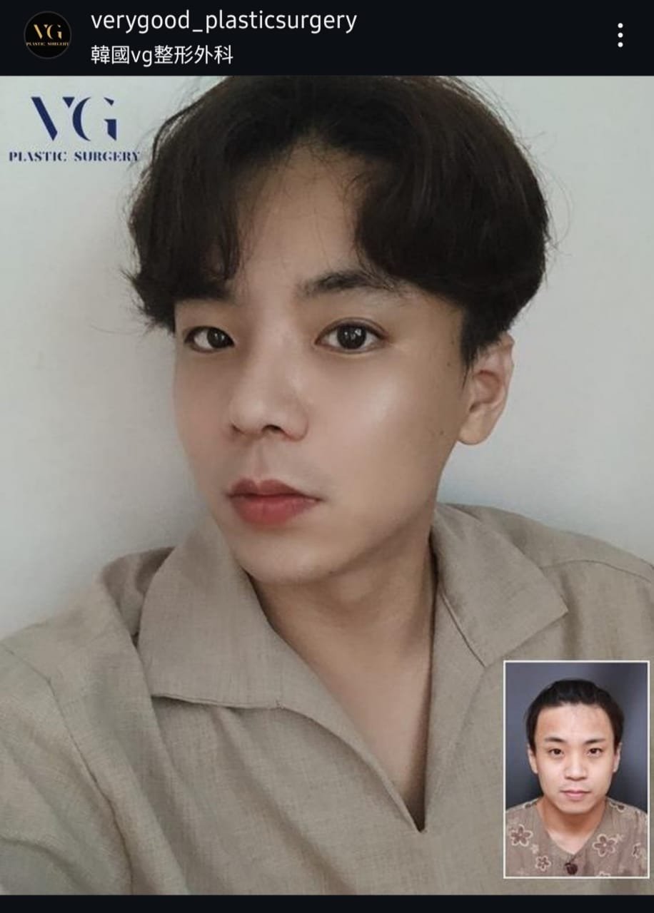 Before and after result by Dr. Im Young Min