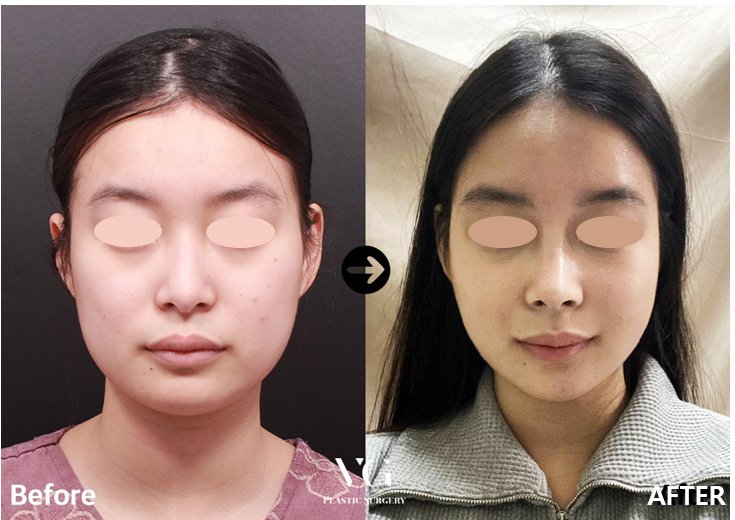 Before and after result by Dr. Kim Yong Woo