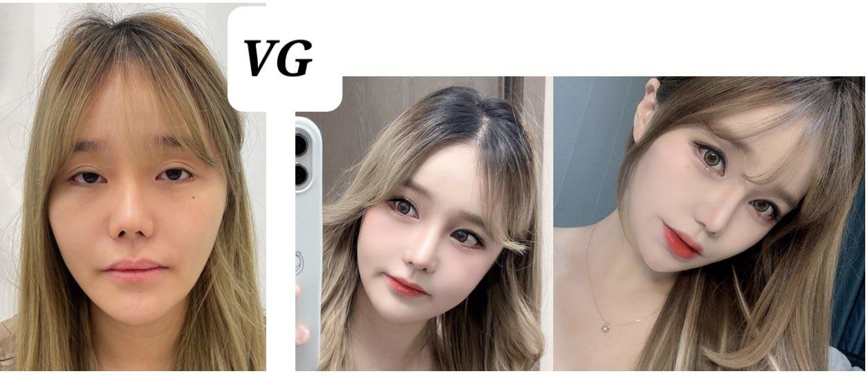 Before and after result by Dr. Kim Yong Woo