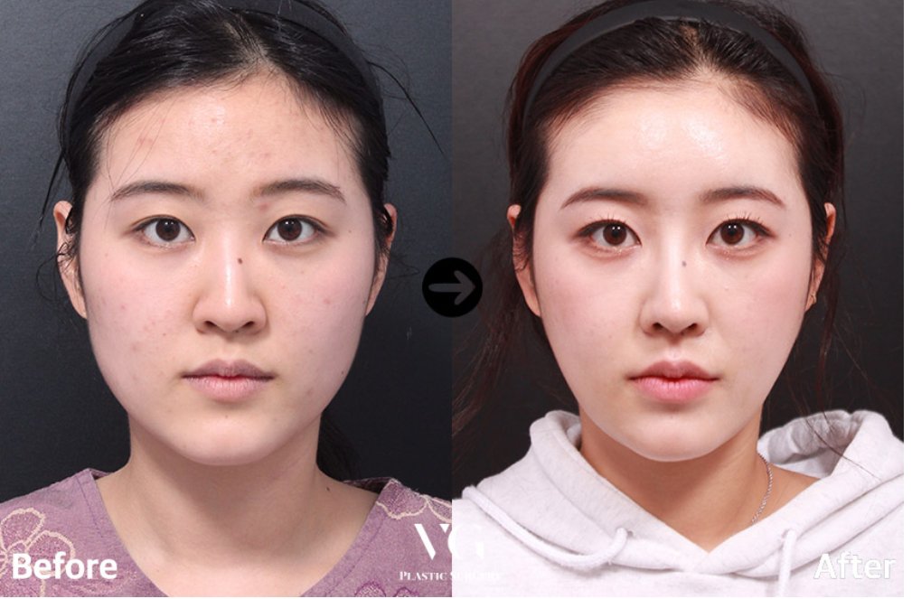 Before and after result by Dr. Kim Yong Woo