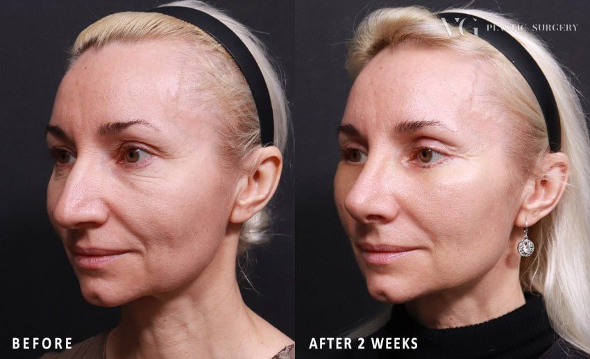 Before and after result by Dr. Im Young Min