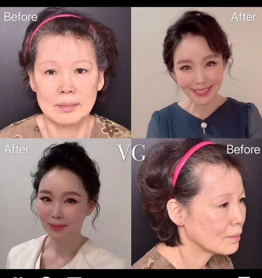 Before and after result by Dr. Kim Yong Woo