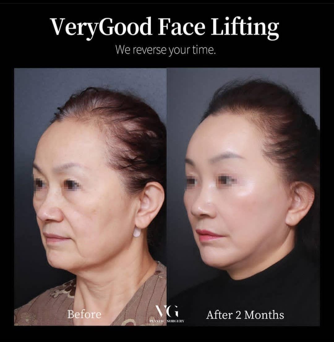 Before and after result by Dr. Im Young Min