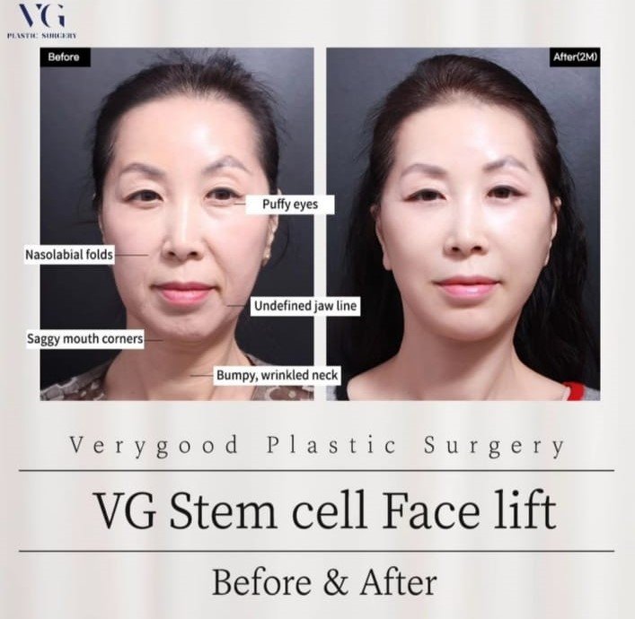 Before and after result by Dr. Kim Yong Woo