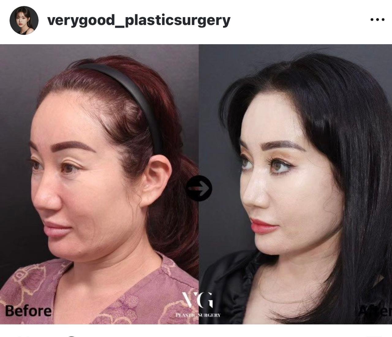 Before and after result by Dr. Kim Yong Woo