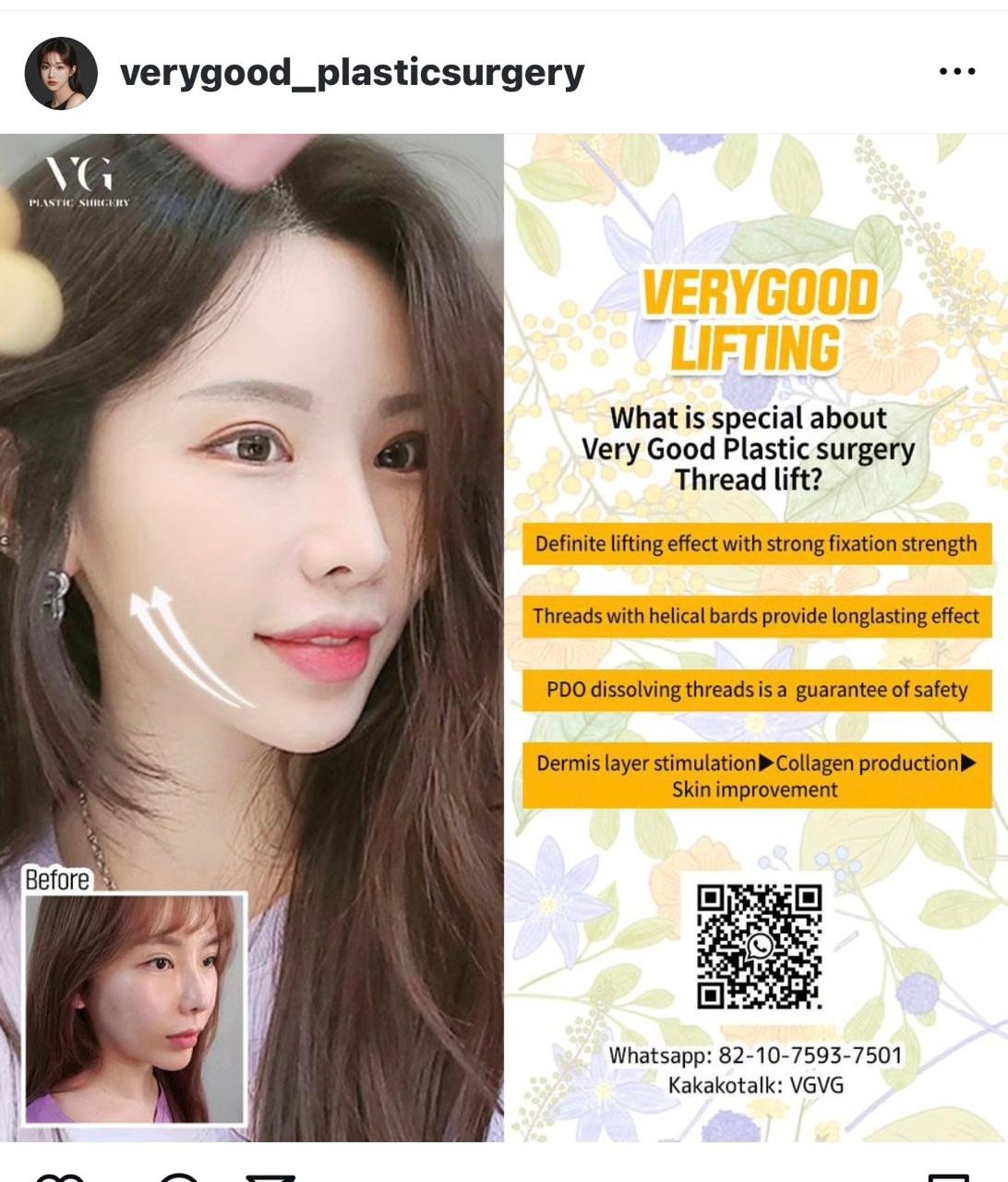 Before and after result by Dr. Im Young Min